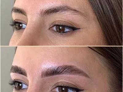 Browlift