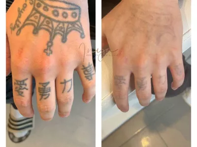 Détatouage